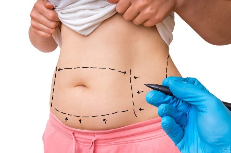 Tummy Tuck Beverly Hills CA