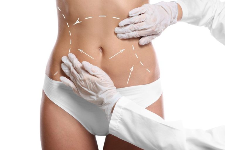 Tummy Tuck Beverly Hills CA