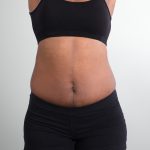 Tummy Tuck/Abdominoplasty Before & After Patient #880
