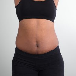Tummy Tuck/Abdominoplasty Before & After Patient #880