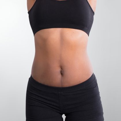 Tummy Tuck/Abdominoplasty Before & After Patient #880